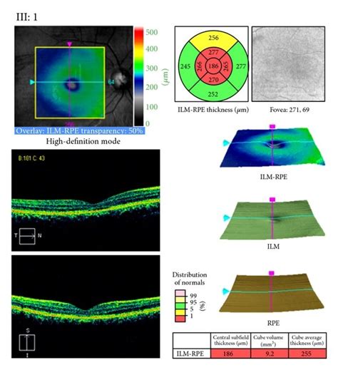 oct macular thickness measurements|macular cube 512x128 meaning.